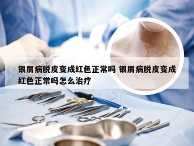 银屑病脱皮变成红色正常吗 银屑病脱皮变成红色正常吗怎么治疗