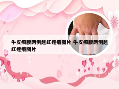牛皮癣腰两侧起红疙瘩图片 牛皮癣腰两侧起红疙瘩图片