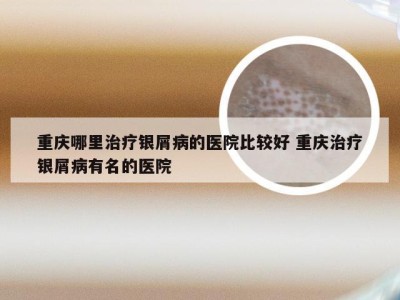 重庆哪里治疗银屑病的医院比较好 重庆治疗银屑病有名的医院