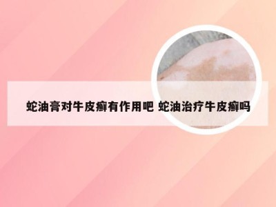 蛇油膏对牛皮癣有作用吧 蛇油治疗牛皮癣吗