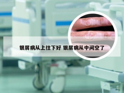 银屑病从上往下好 银屑病从中间空了
