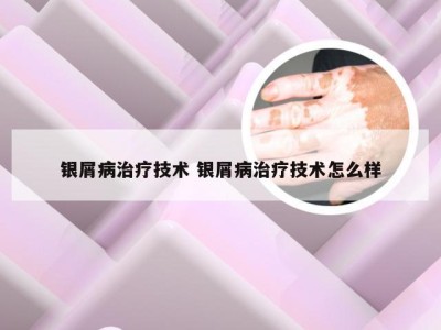 银屑病治疗技术 银屑病治疗技术怎么样