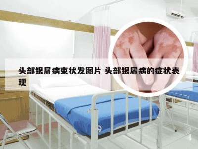 头部银屑病束状发图片 头部银屑病的症状表现