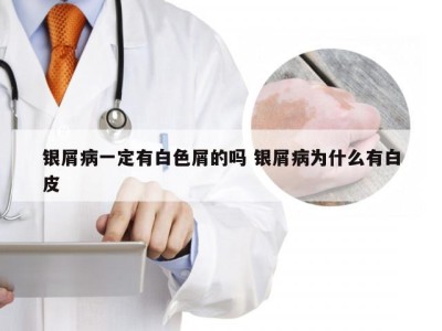银屑病一定有白色屑的吗 银屑病为什么有白皮