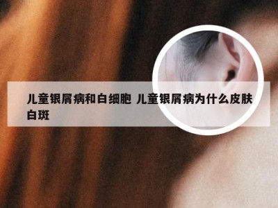 儿童银屑病和白细胞 儿童银屑病为什么皮肤白斑