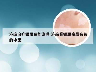济南治疗银屑病能治吗 济南看银屑病最有名的中医