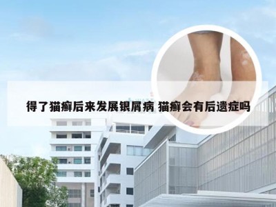 得了猫癣后来发展银屑病 猫癣会有后遗症吗