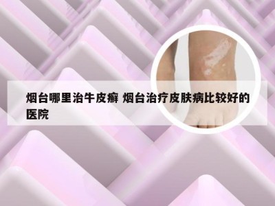 烟台哪里治牛皮癣 烟台治疗皮肤病比较好的医院