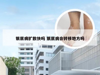 银屑病扩散快吗 银屑病会转移地方吗