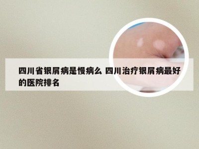 四川省银屑病是慢病么 四川治疗银屑病最好的医院排名