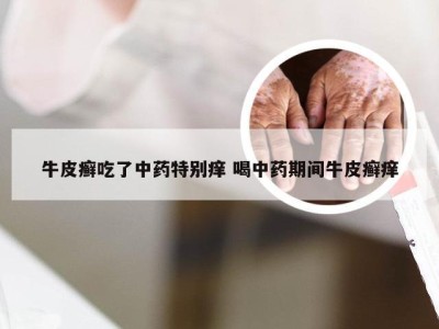 牛皮癣吃了中药特别痒 喝中药期间牛皮癣痒