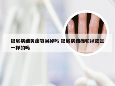 银屑病结黄痂容易掉吗 银屑病结痂和掉皮是一样的吗