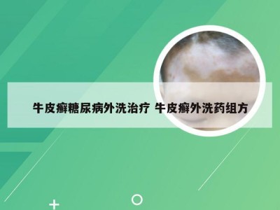 牛皮癣糖尿病外洗治疗 牛皮癣外洗药组方
