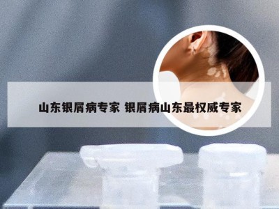 山东银屑病专家 银屑病山东最权威专家