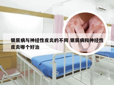 银屑病与神经性皮炎的不同 银屑病和神经性皮炎哪个好治