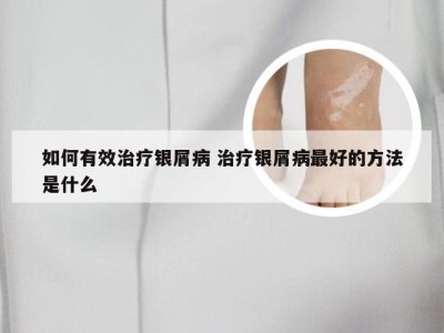 如何有效治疗银屑病 治疗银屑病最好的方法是什么
