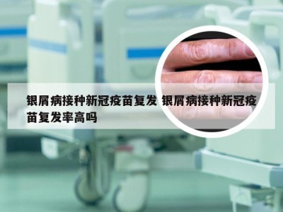 银屑病接种新冠疫苗复发 银屑病接种新冠疫苗复发率高吗