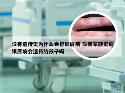 没有遗传史为什么会得银屑病 没有家族史的银屑病会遗传给孩子吗