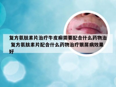 复方氨肽素片治疗牛皮癣需要配合什么药物治 复方氨肽素片配合什么药物治疗银屑病效果好