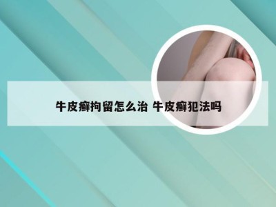 牛皮癣拘留怎么治 牛皮癣犯法吗