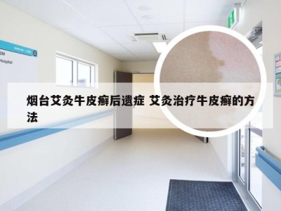 烟台艾灸牛皮癣后遗症 艾灸治疗牛皮癣的方法