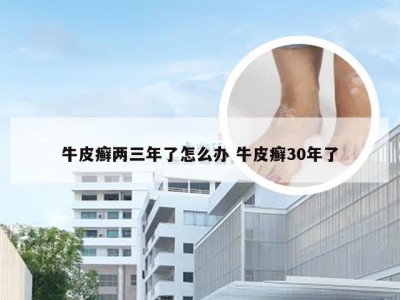 牛皮癣两三年了怎么办 牛皮癣30年了