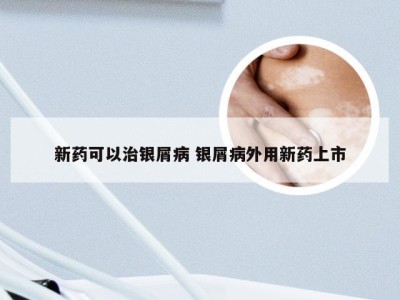 新药可以治银屑病 银屑病外用新药上市