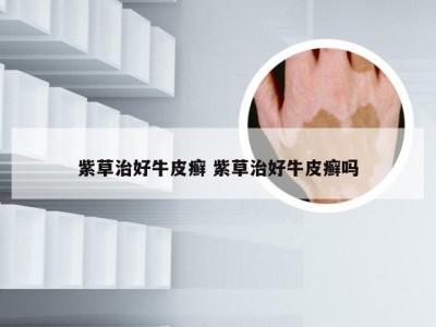 紫草治好牛皮癣 紫草治好牛皮癣吗