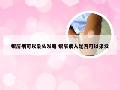 银屑病可以染头发嘛 银屑病人是否可以染发