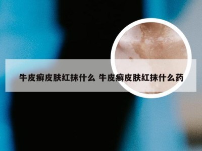 牛皮癣皮肤红抹什么 牛皮癣皮肤红抹什么药