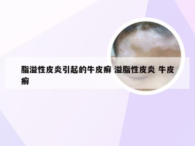 脂溢性皮炎引起的牛皮癣 溢脂性皮炎 牛皮癣