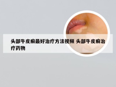 头部牛皮癣最好治疗方法视频 头部牛皮癣治疗药物