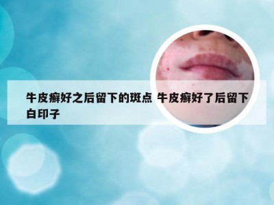 牛皮癣好之后留下的斑点 牛皮癣好了后留下白印子