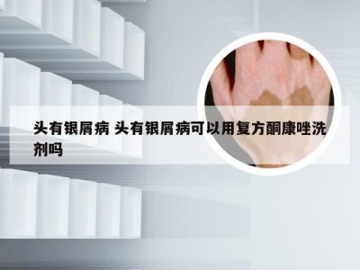 头有银屑病 头有银屑病可以用复方酮康唑洗剂吗