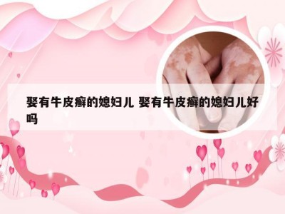 娶有牛皮癣的媳妇儿 娶有牛皮癣的媳妇儿好吗