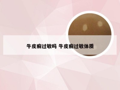 牛皮癣过敏吗 牛皮癣过敏体质