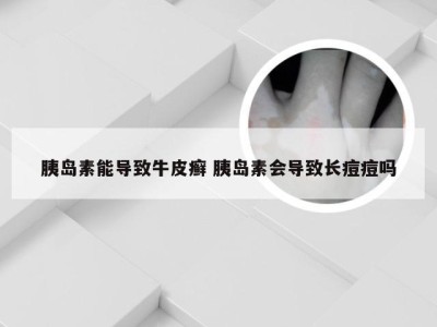 胰岛素能导致牛皮癣 胰岛素会导致长痘痘吗