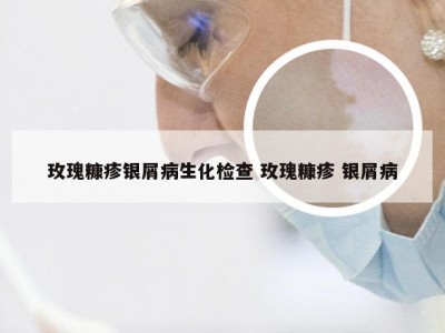 玫瑰糠疹银屑病生化检查 玫瑰糠疹 银屑病