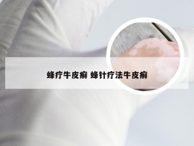 蜂疗牛皮癣 蜂针疗法牛皮癣