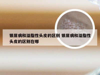 银屑病和溢脂性头皮的区别 银屑病和溢脂性头皮的区别在哪