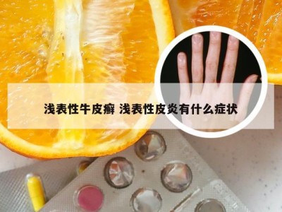 浅表性牛皮癣 浅表性皮炎有什么症状