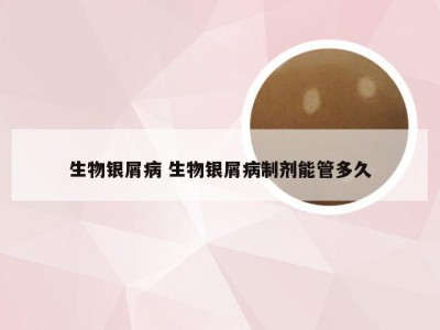 生物银屑病 生物银屑病制剂能管多久
