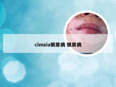 cimzia银屑病 银屑病