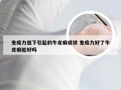 免疫力低下引起的牛皮癣症状 免疫力好了牛皮癣能好吗