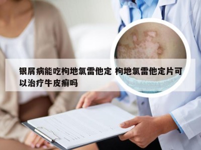 银屑病能吃枸地氯雷他定 枸地氯雷他定片可以治疗牛皮癣吗