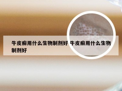 牛皮癣用什么生物制剂好 牛皮癣用什么生物制剂好