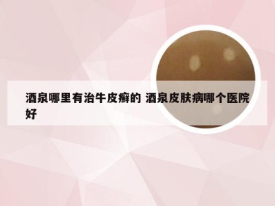 酒泉哪里有治牛皮癣的 酒泉皮肤病哪个医院好
