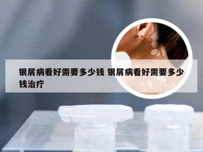 银屑病看好需要多少钱 银屑病看好需要多少钱治疗