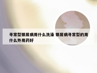 寻常型银屑病用什么洗澡 银屑病寻常型的用什么外用药好