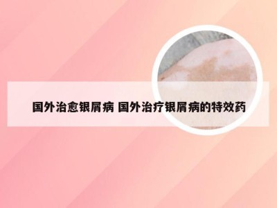 国外治愈银屑病 国外治疗银屑病的特效药